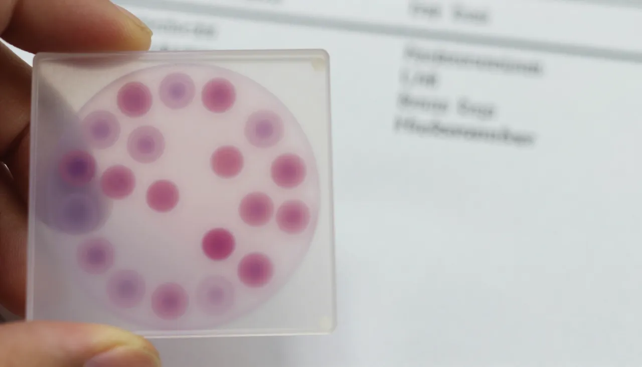 Blood smear microscope slide showing normal-sized pale red cells beside a CBC lab report at a Bhubaneswar clinic — Normocytic Anaemia