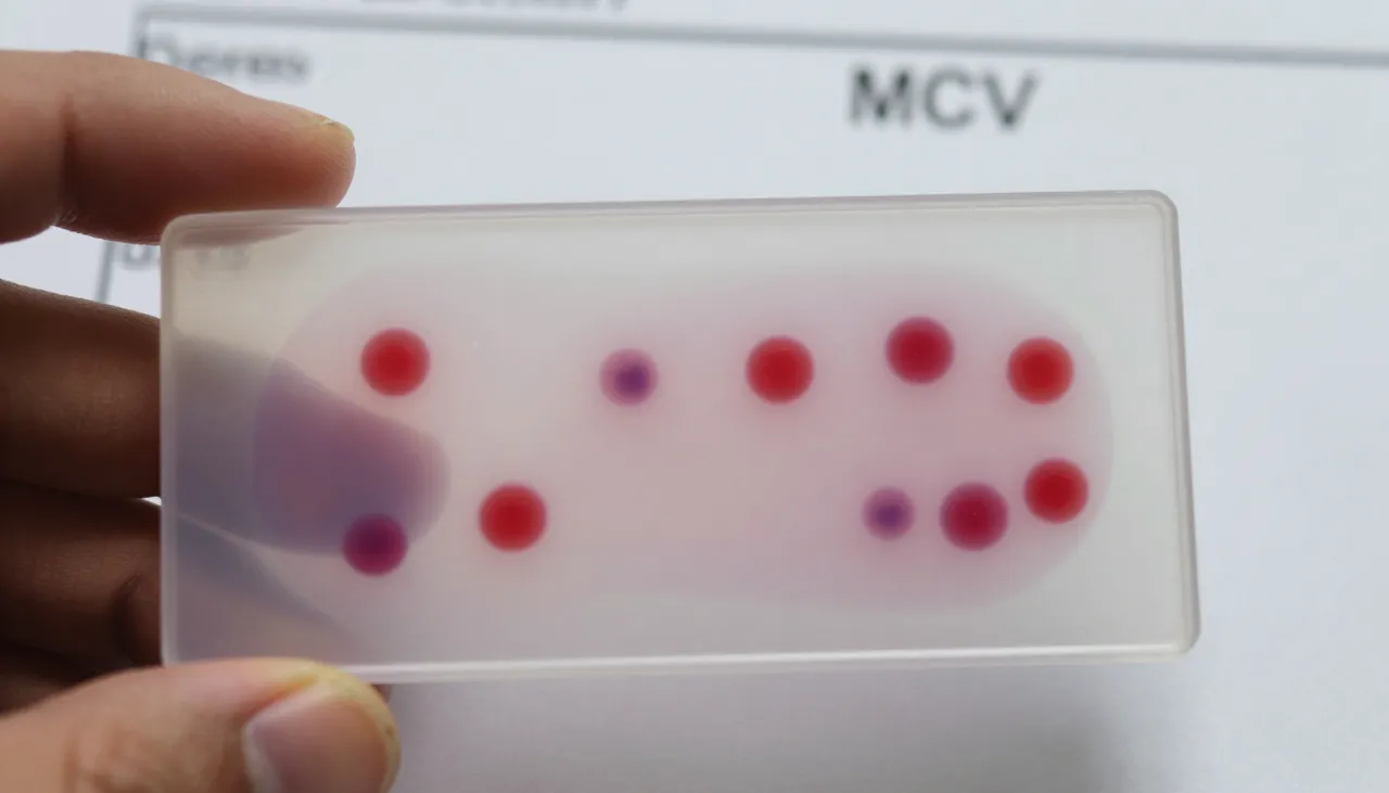 Blood smear microscope slide showing small red cells beside a CBC lab report with low MCV at a Bhubaneswar clinic — Microcytic Anaemia